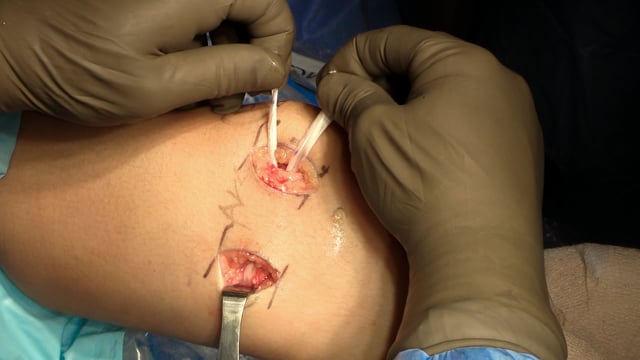 Physeal-sparing Medial Patellofemoral Ligament Reconstruction