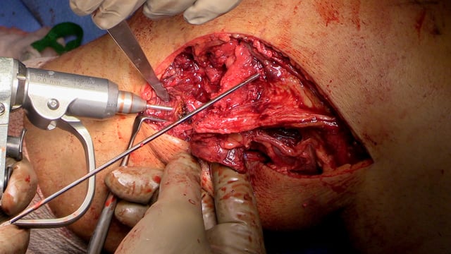 Staged Reconstruction of a Multiligamentous Knee Injury – ACL, PCL, PLC