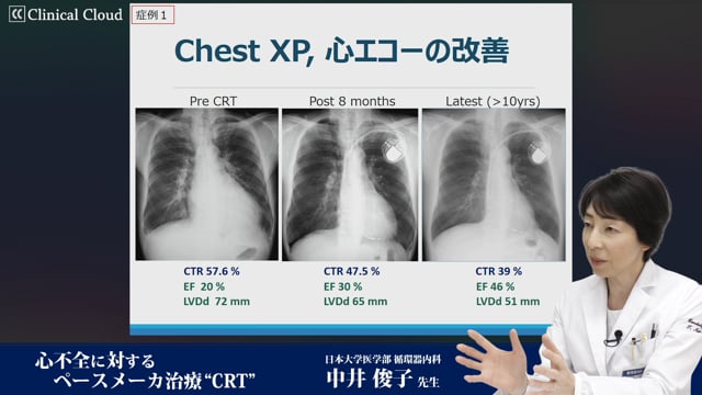 心不全に対するペースメーカ治療 ”CRT" -Part2-