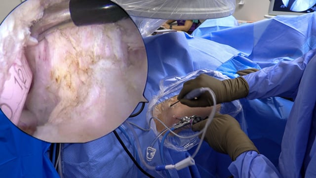 Arthroscopic Iliopsoas Tenotomy for Treatment of Snapping Hip after total Hip Arthroplasty