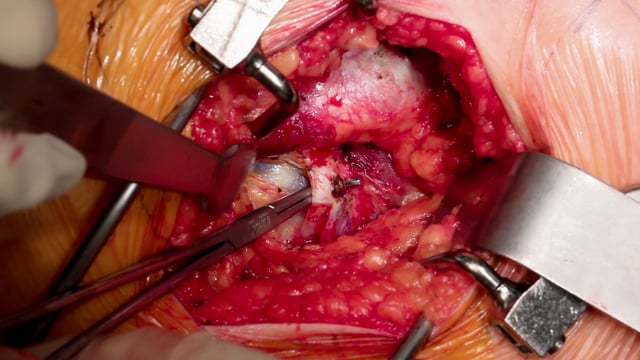 Piriformis Syndrome Surgery