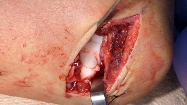 Osteochondral Autograft Transfer for OCD Lesion of Humeral Capitellum in an Adolescent Pitcher