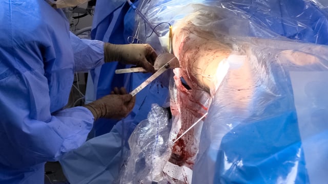 Arthroscopic Labral Repair and Open Derotational Osteotomy for FAI with Excessive Anteversion
