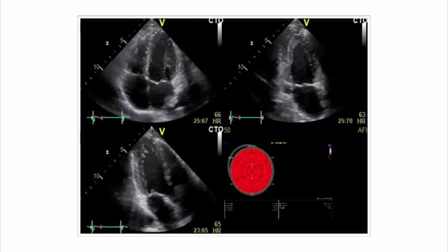 How would a normal and abnormal speckle tracking echo look like?