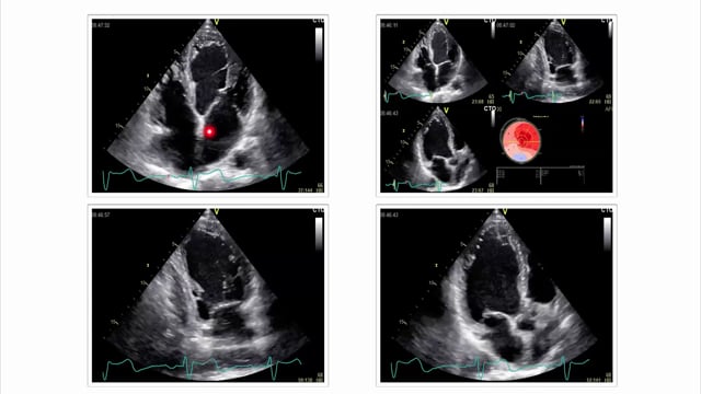 What would a myocardial scar look like in STE?