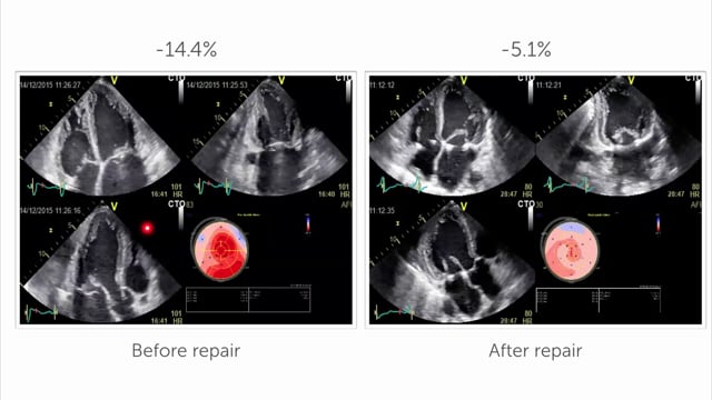 Why should you use speckle tracking in mitral regurgitation?