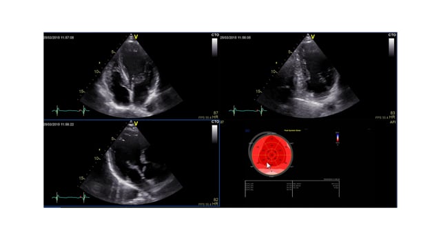 Case study: 28y/o male with aortic valve disease and the value of strain