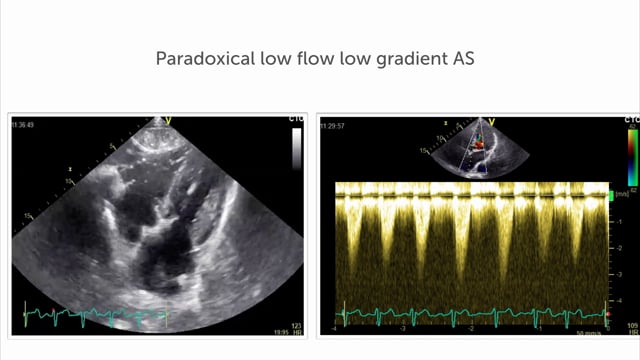 What is the role of strain in paradox low flow low gradient aortic stenosis?