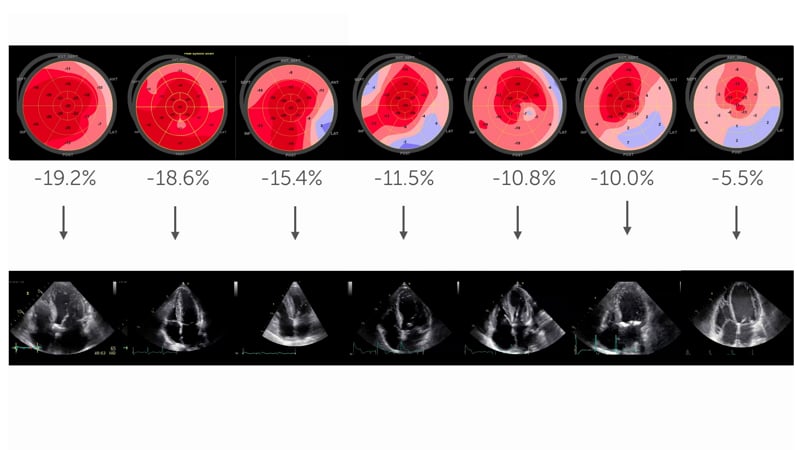 Why is strain better than ejection fraction?