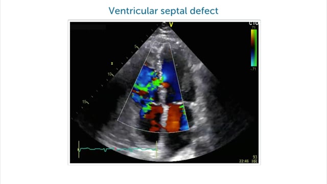 Why is color Doppler important for echocardiography?