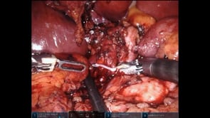 Robotic Whipple (Pancreaticoduodenectomy)