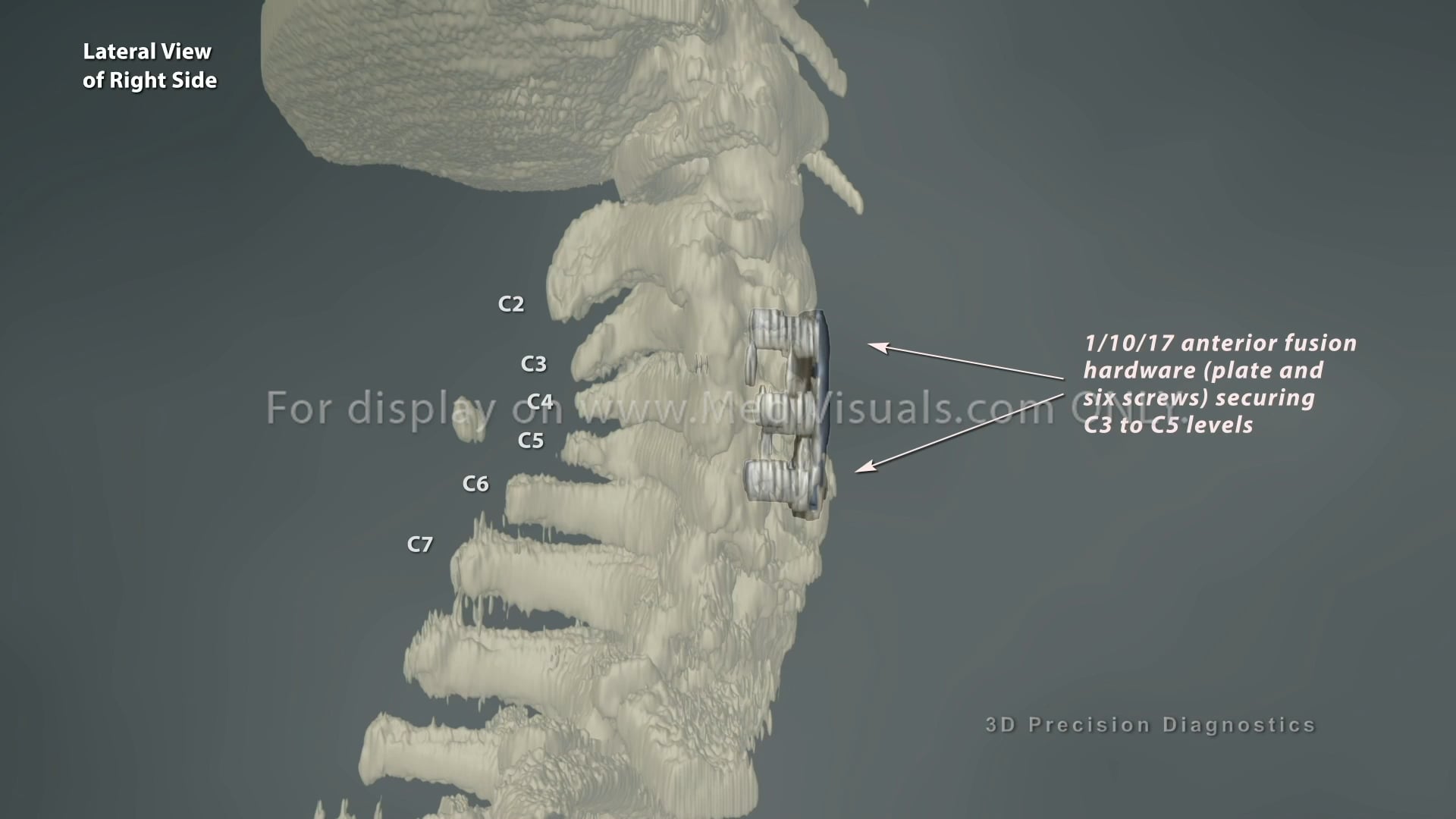 Cervical Spine Fusion Hardware CT Findings (R3318507X) on Vimeo
