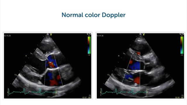 What kinds of pathology can I see in the parasternal long-axis view?