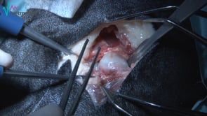 Artroplastia cabeza-cuello femoral