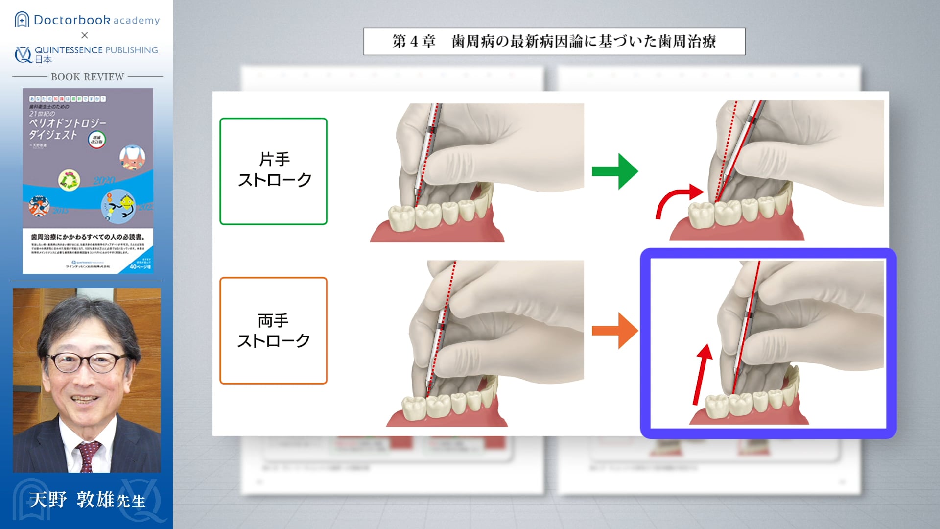 #2 キュレットの刃の当て方