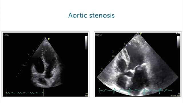 What other apical views than the 4 chamber view are there?