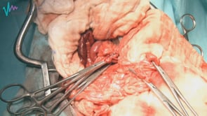 Esplenectomía de urgencia