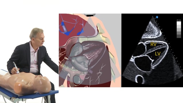 What can I see in a good subcostal view?