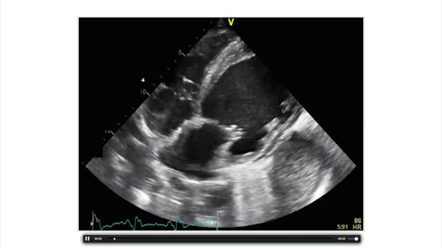 What pathologies can I see in a subcostal view?