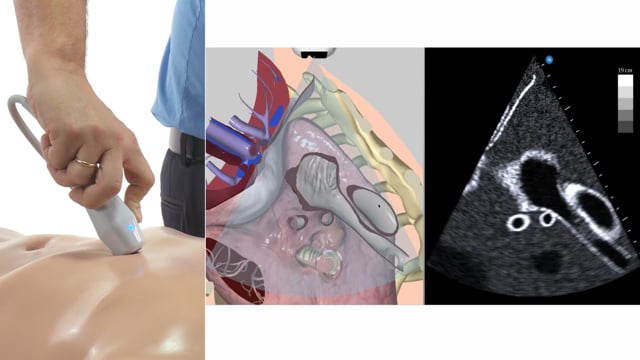 How can I image the IVC with ultrasound?