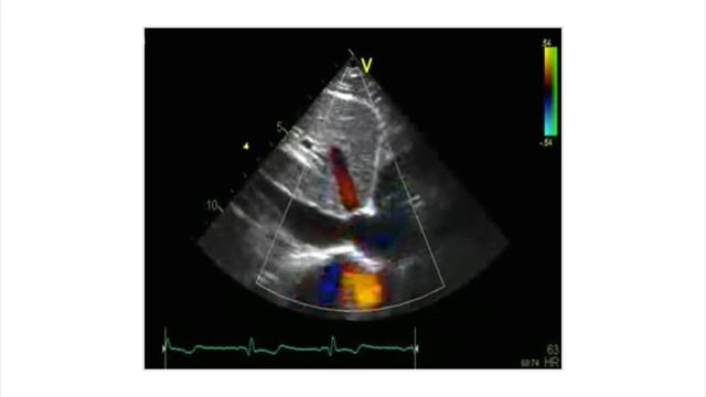 Why should I look at the IVC with ultrasound?