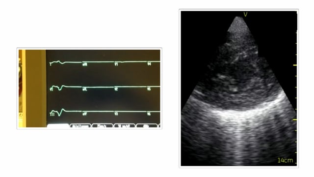 What is a pseudo PEA, and what does it mean for the patient?