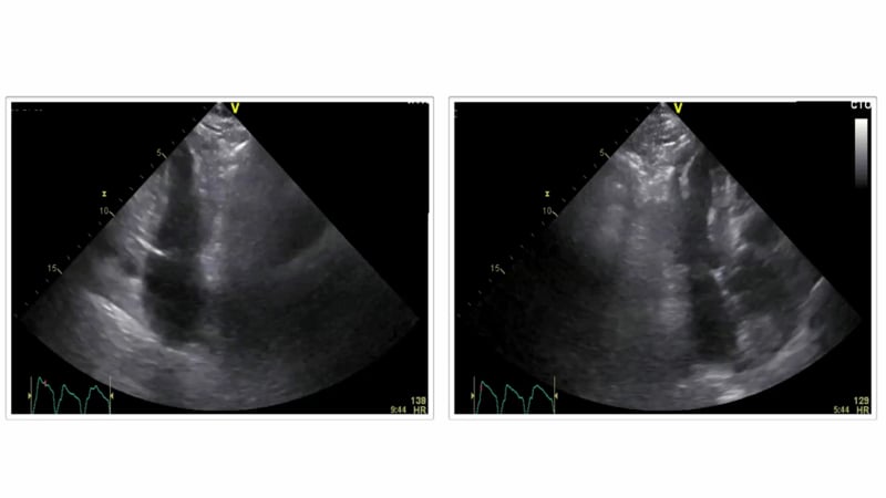 what-does-cardiac-arrest-look-like-in-echocardiography