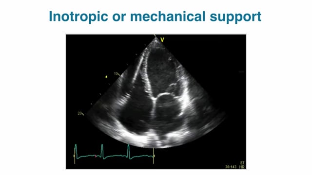 How can echocardiography help diagnose cardiogenic shock?