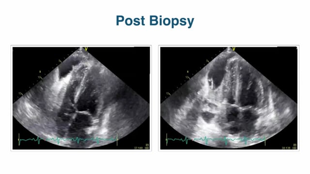 How do I diagnose tamponade with echocardiography?