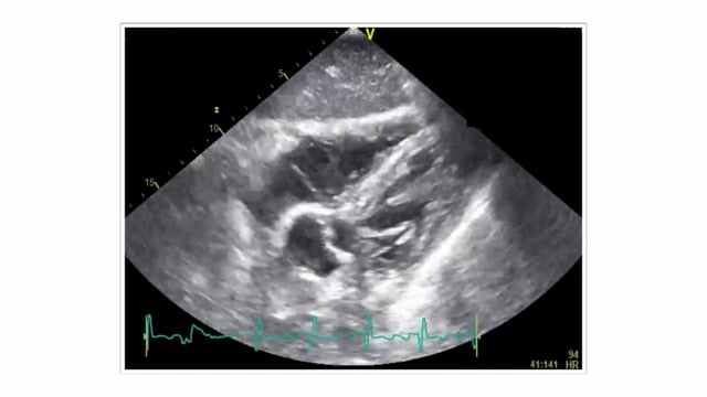 How can I diagnose pulmonary embolism on ultrasound in an emergency situation?