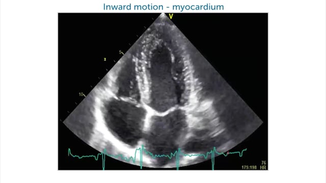 How can left ventricular function be assessed without measurements?