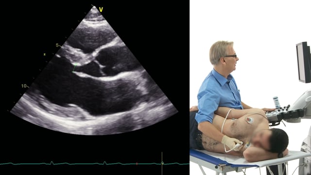 What is E-point septal separation (EPSS)?