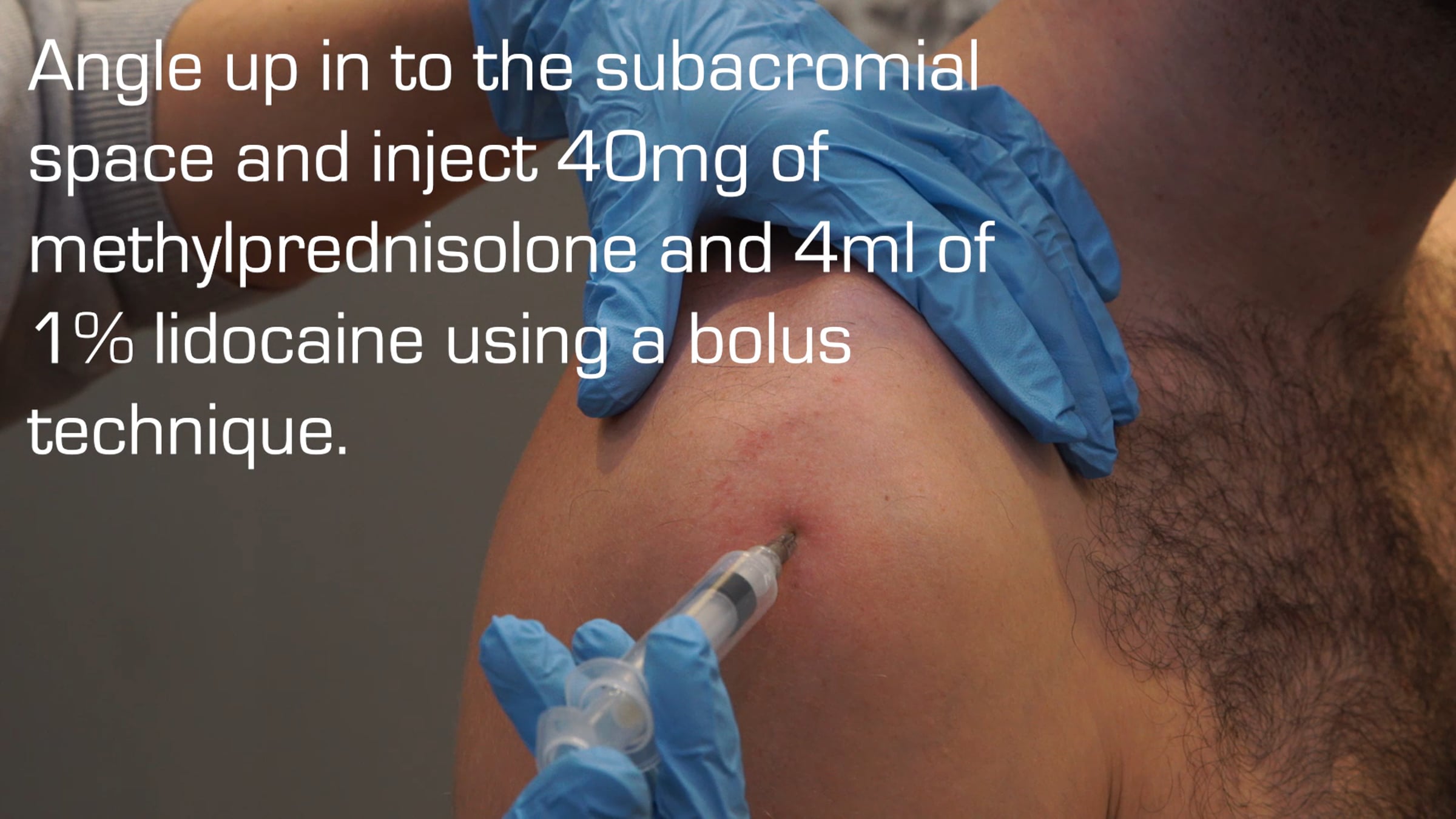 Injection into the Subacromial Space for Subacromial Pain Syndrome