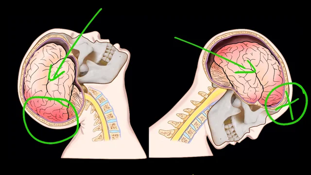 Coup Contrecoup Injury Symptoms