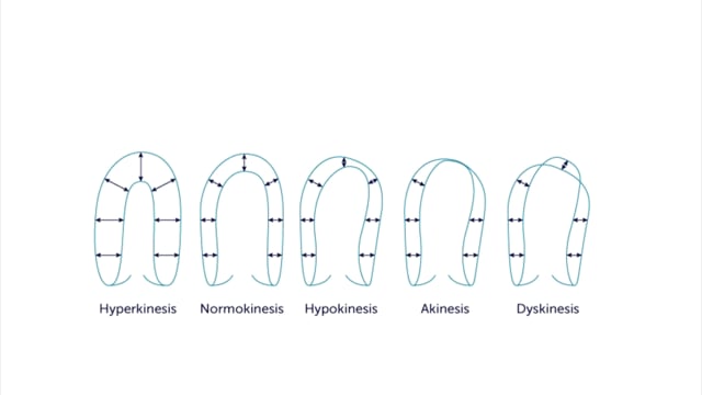 How can wall motion abnormalities be quantified?