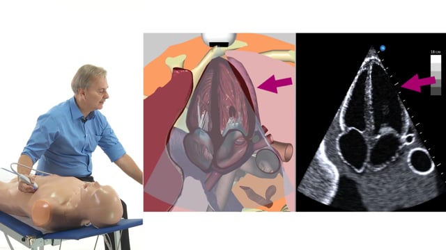 Which views should be used to assess wall motion abnormalities?