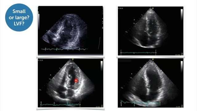 How can the size of myocardial infarctions be assessed? How can new myocardial infarctions be differentiated from old ones?