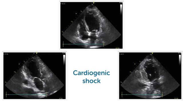 Why is left ventricular function so important in myocardial infarction and what are signs of low cardiac output?