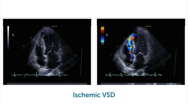 What are typical sites of ischaemic ventricular septal defects?