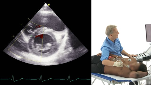 Which views should be used to detect ischemic VSD?