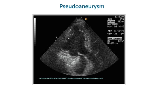 What are echo features of ventricular rupture and pseudoaneurysms?