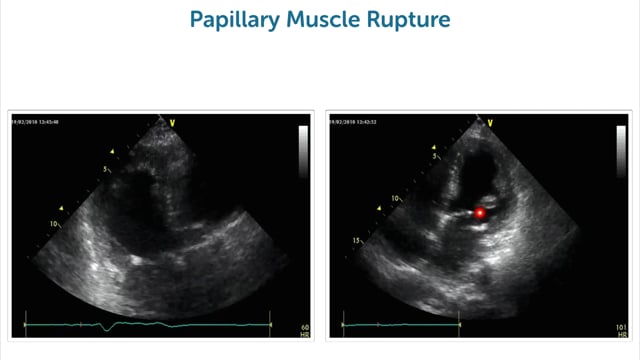 What are the typical echo signs of papillary muscle rupture?