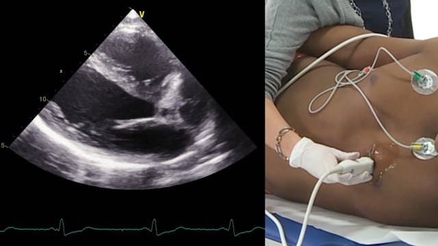 How can a ruptured papillary muscle best be imaged?