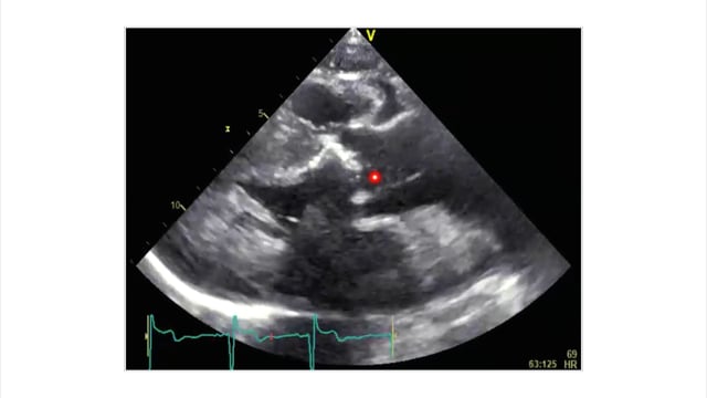 What are the most frequent causes of left ventricular hypertrophy?