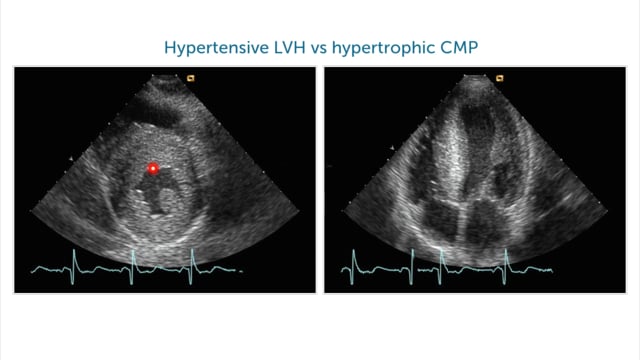 What is the difference between hypertrophic CMP and other forms of left ventricular hypertrophy?