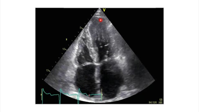 Examples of hypertrophic cardiomyopathy