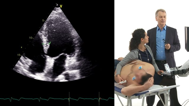 Are these echos showing hypertrophic cardiomyopathy?