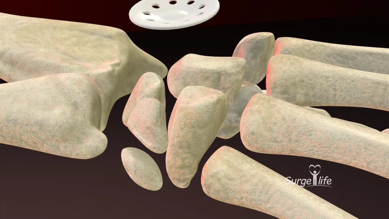 Arthrodèse 4 os + scaphoïdectomie Dr Renaud DUCHÉ Avignon on Vimeo — free download