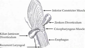 Upper Esophageal Diverticula – Per Oral Endoscopic Myotomy