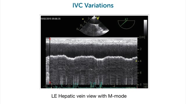 What is the role of respiratory variations in volume status?